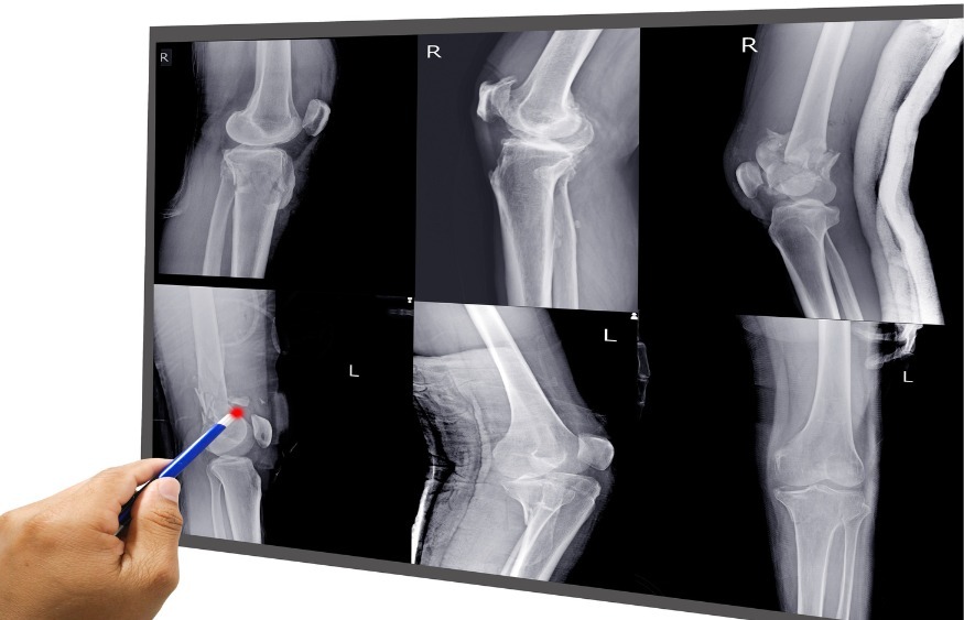 Digital X-Ray Knee Joint